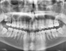 Prédiction du risque de fractures par des radiographies dentaires