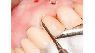 Exo Safe : l’extraction atraumatique et mini-invasive
