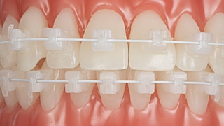 TRUKLEAR / FORESTADENT - Brackets autoligaturants disponibles de 5 à 5 en maxillaire et mandibulaire