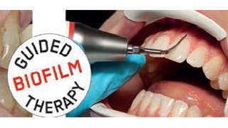 GUIDED BIOFILM THERAPY D’EMS