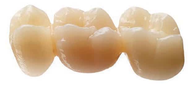 Sivp dentaire / zircone-tech - un partenariat qui offre des couronnes full zircone multicouches à très haute translucidité