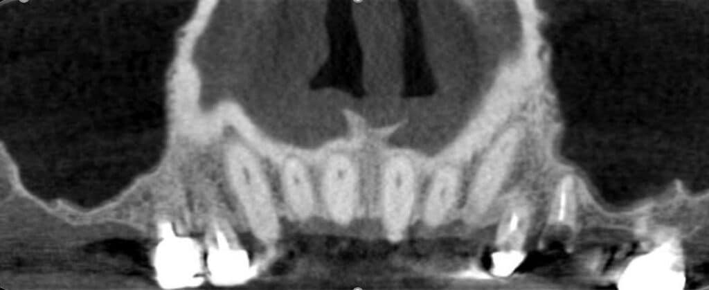 Fig.2 : Coupe frontale au début du traitement des deux sinus maxillaires.