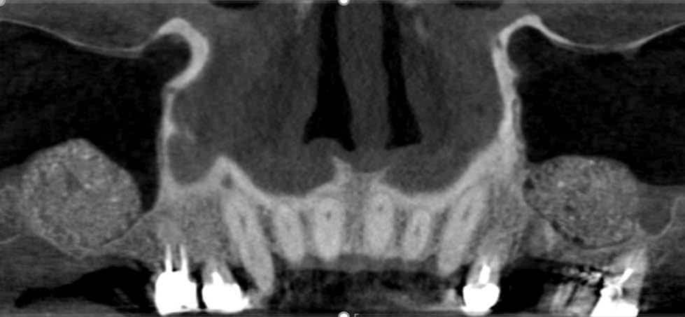 Fig.3 : Coupe frontale après les deux comblements sinusiens à l’aide de biomatériau allogénique.