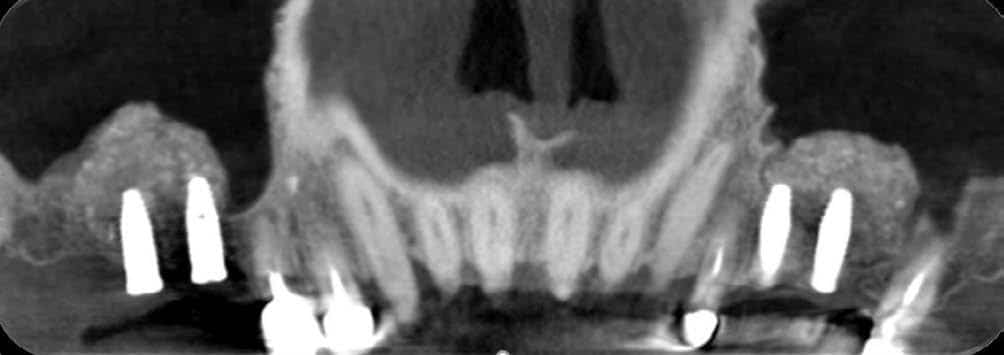 Fig.4 : Étape de la mise en place de 4 implants IDALL en 16, 17, 25 et 26.