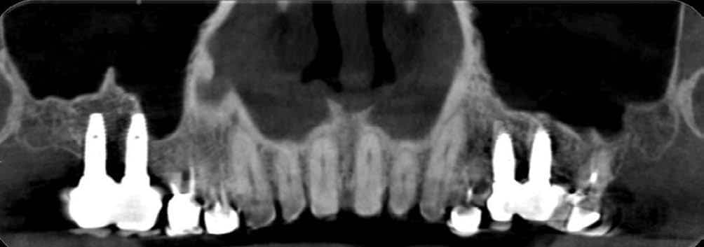 Fig.5 : Coupe frontale cone beam au contrôle après 6 années.