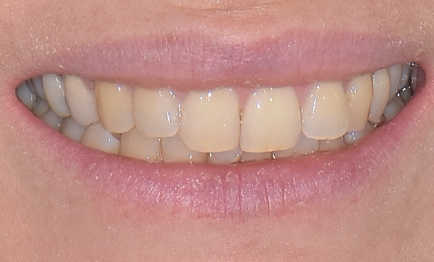 Dents alignées