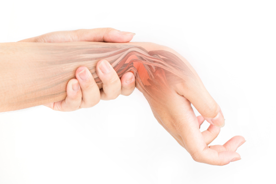 Tout savoir sur le syndrome du canal carpien