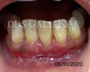 Récession gingivale, situation à trois mois.