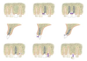 Quatre points cardinaux implants.