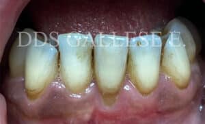 Récession gingivale avec une récession de classe 2 de Miller