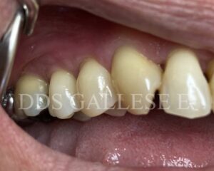 Récessions gingivales traitées.