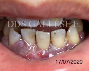 Traitement récession gingivale
