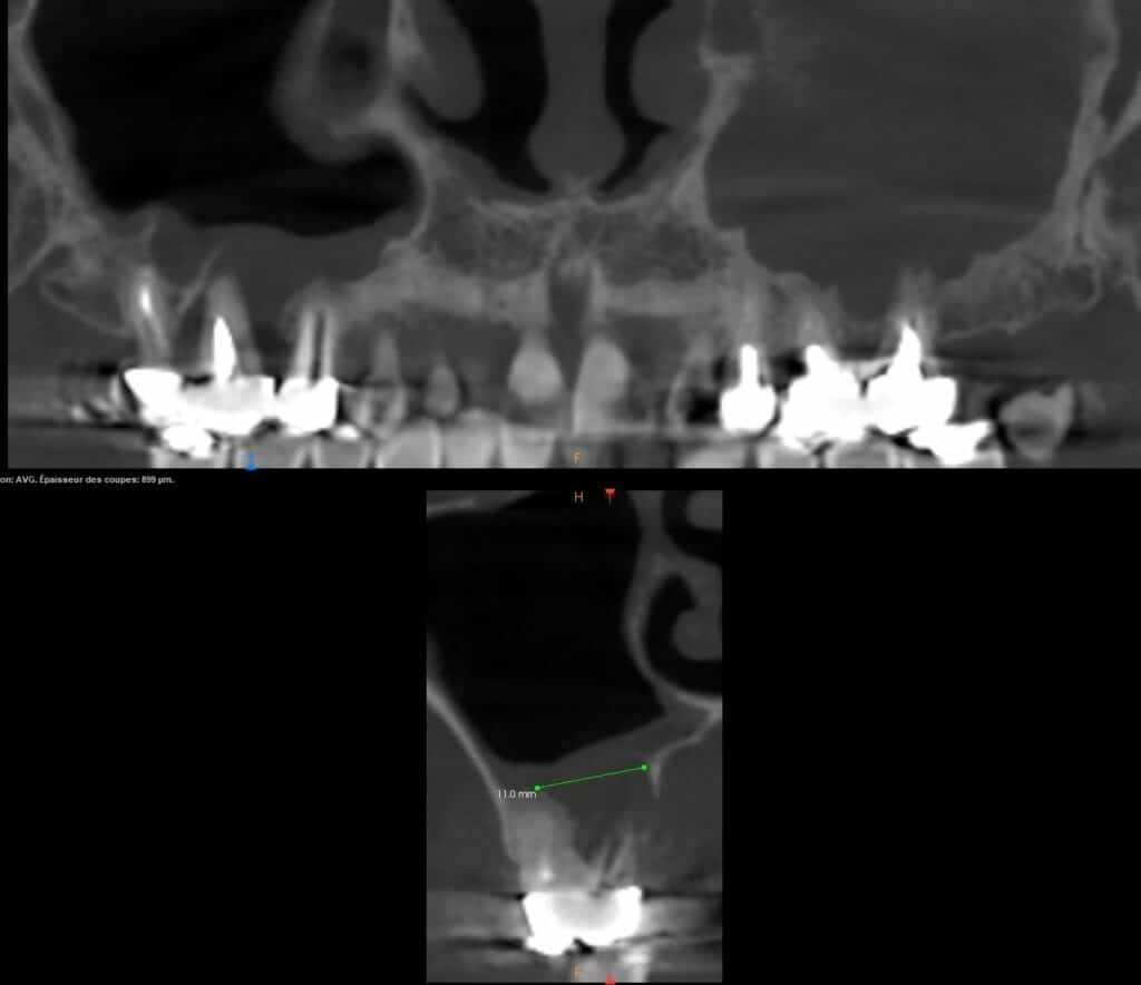Cone beam préopératoire