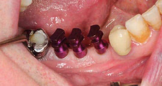 Fig.14 : Transferts d’implants clipsés sur les implants avant empreinte.