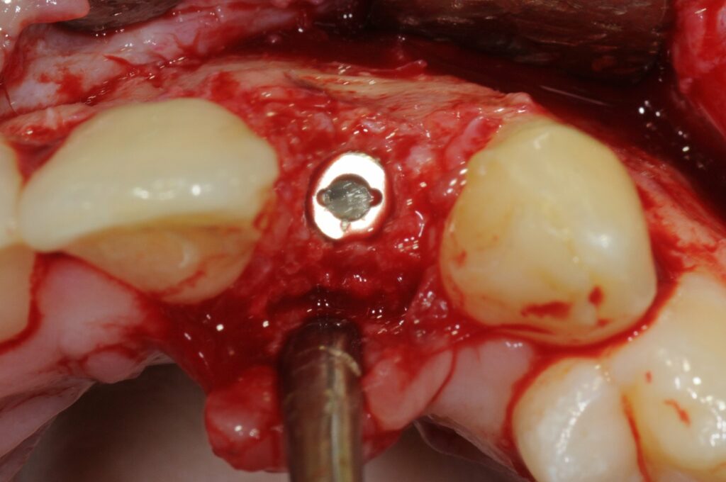 Insertion d'un implant Xive 3,4/11 mm.