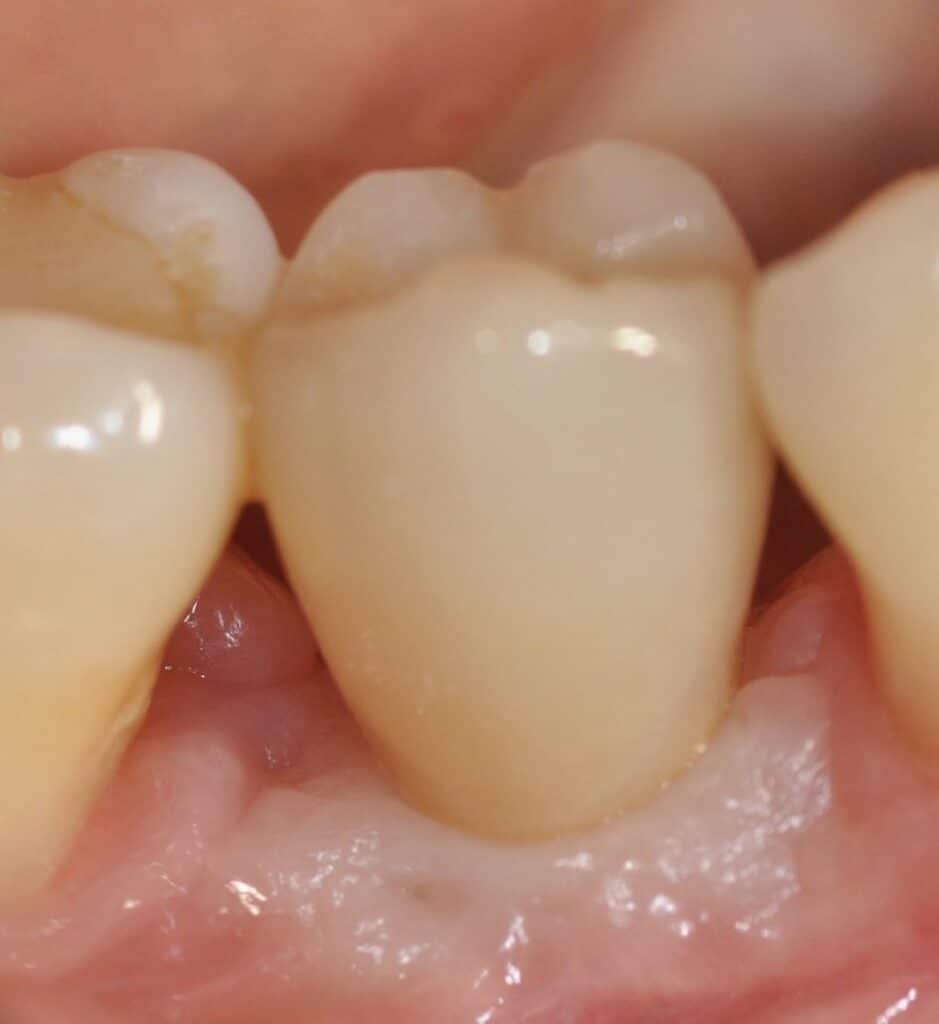 Intégration tissulaire d'une reconstruction céramo-céramique sur implant en zircone.