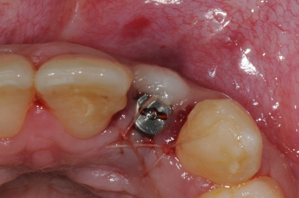 Sutures du lambeau vestibulaire le volume est augmenté en regard de l'implant.