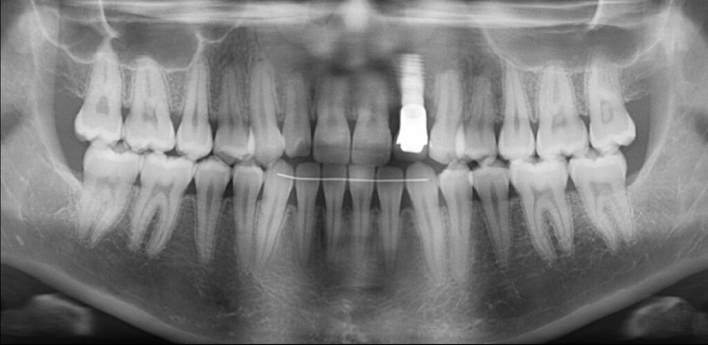 Radiographie de contrôle 5 ans après la restauration prothétique.