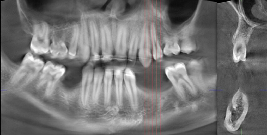 Le CBCT préopératoire met en évidence un défaut vertical associé à un défaut horizontal.