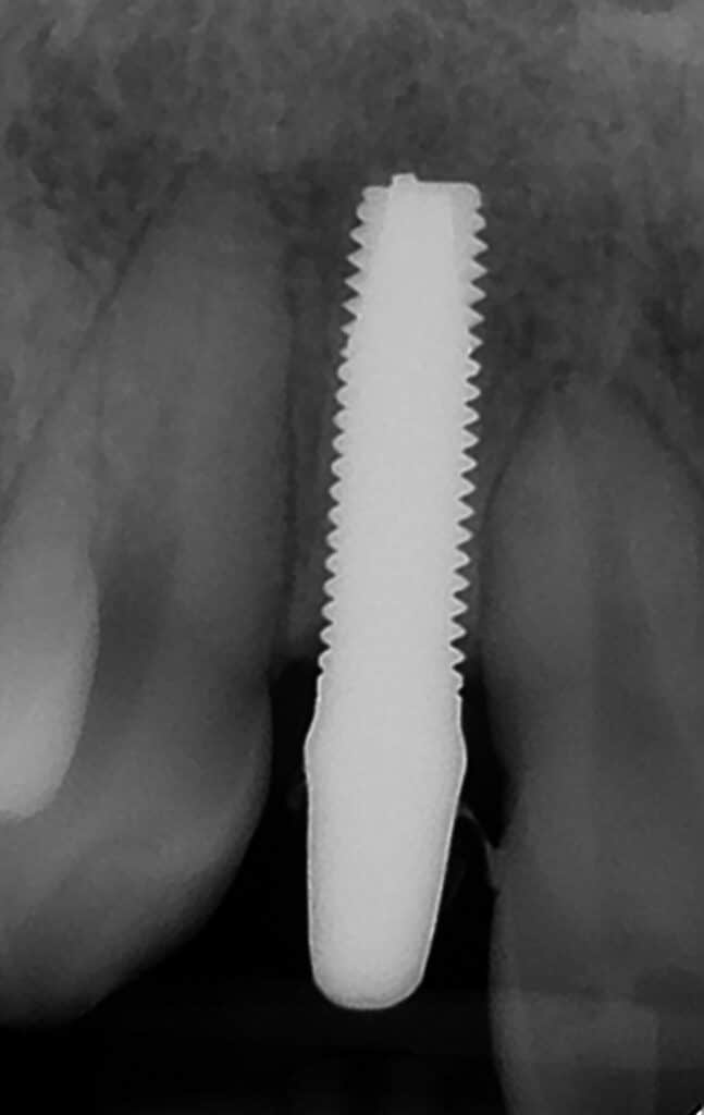 Radio rétroalvéolaire montrant l'ostéointégration de l'implant à 3 mois.
