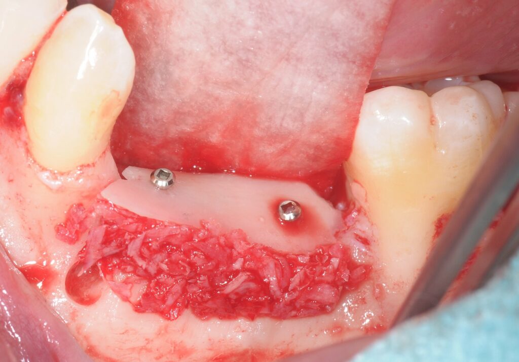 Une membrane lentement résorbable est placée pour stabiliser l'os.