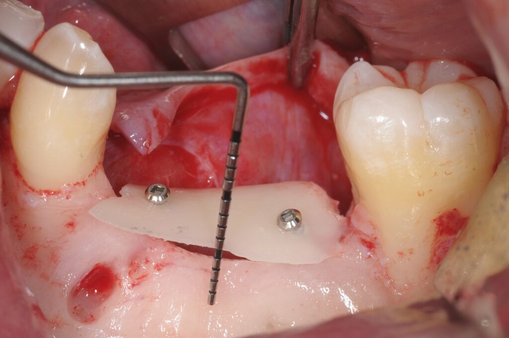 Bloc occlusal fixé avec deux vis d'ostéosynthèse.