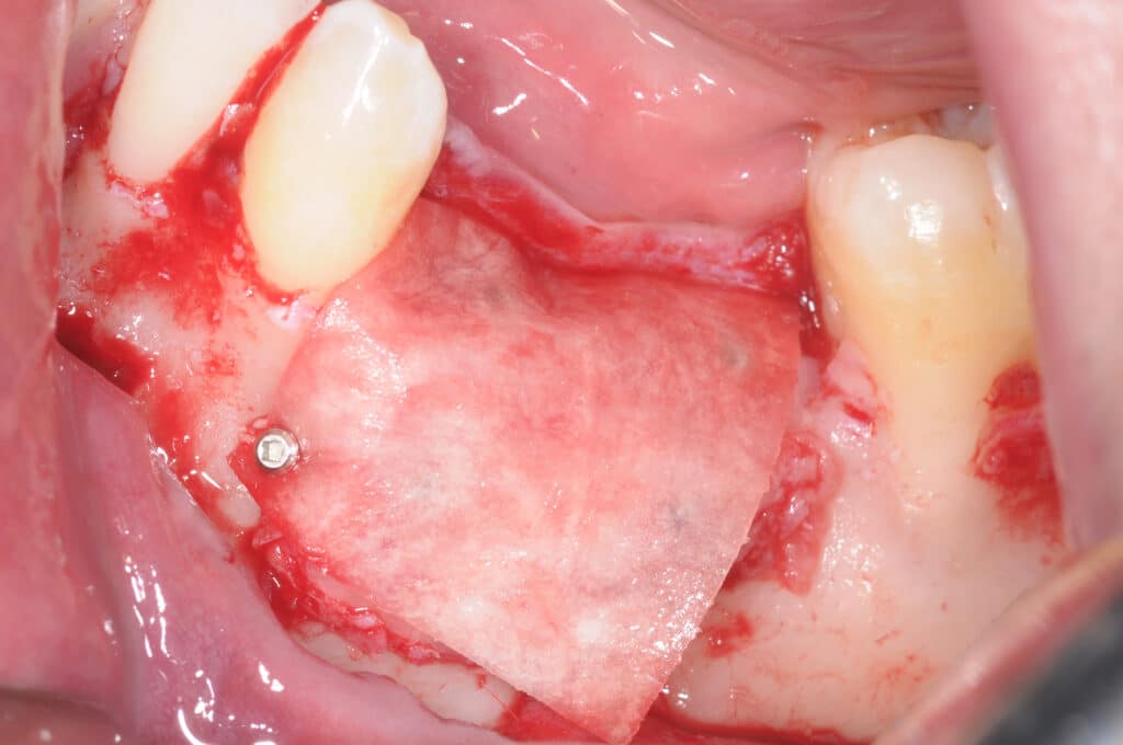 La membrane résorbable est repliée en vestibulaire et fixée avec une vis d'ostéosynthèse.
