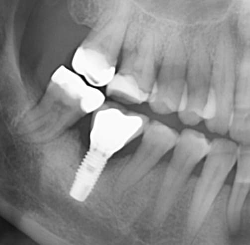 Radiographie montrant le type de lésion osseuse