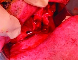 L'implant zygomatique droit une fois en place.