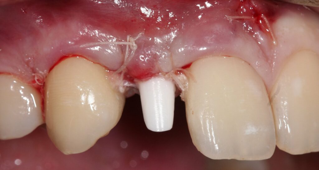 Pose d'un implant monobloc de 3,6 mm de diamètre et greffe pédiculée.