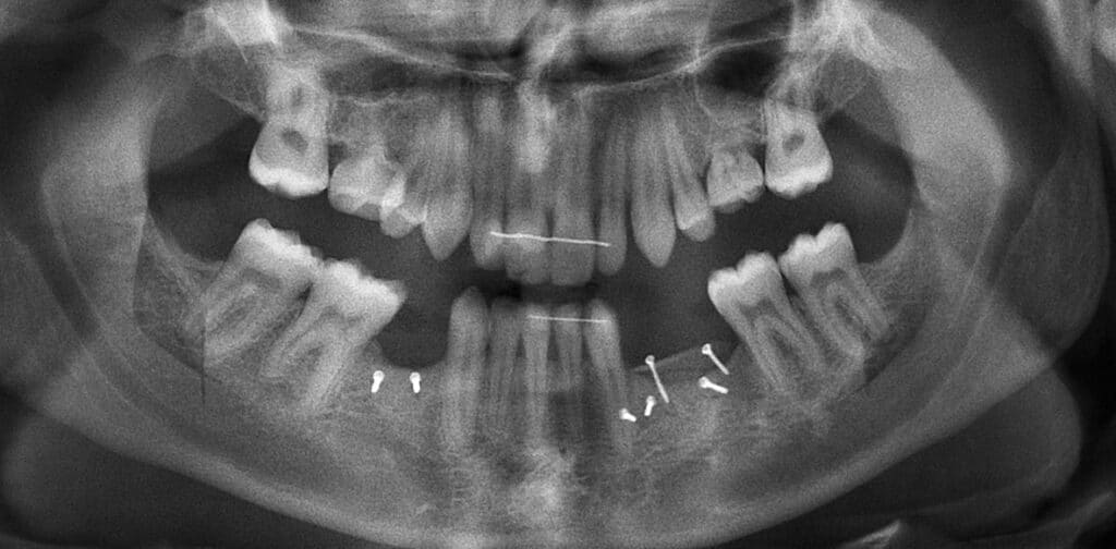 Radiographie panoramique de contrôle montrant le gain vertical.