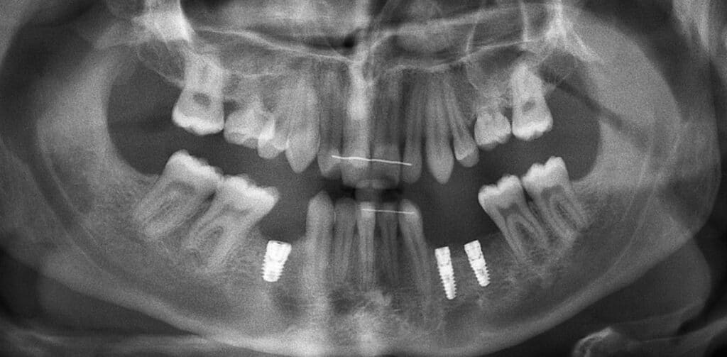 Radiographie panoramique postopératoire montrant la mise en place des deux implants.