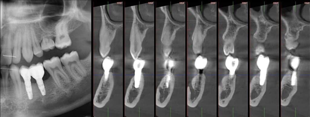 Contrôle radiographique à 3 ans.