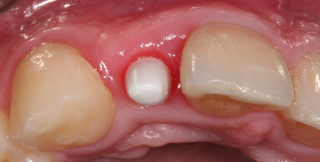 Vue occlusale de la cicatrisation tissulaire avec préparation du pilier prothétique de l'implant monobloc.