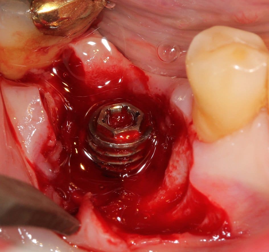 Destruction osseuse avec du tissu de granulation autour de l'implant en titane.