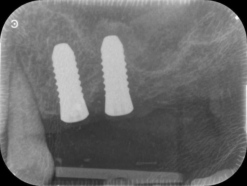 Implants ostéointégrés.
