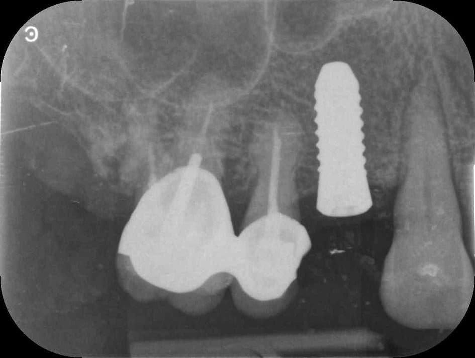 Implants ostéointégrés, l'implant 25 est posé avec un sinus lift par voie crestale.