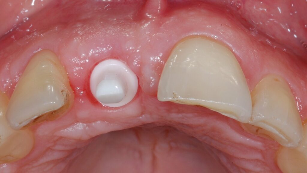 Les dimensions de la muqueuse péri-implantaire autour des implants en zircone sont similaires par rapport aux implants en titane.