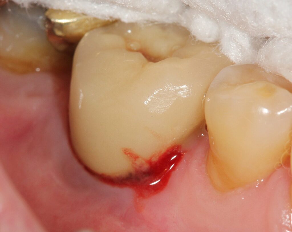 Péri-implantite autour d'un implant en 46 et sa CCM.