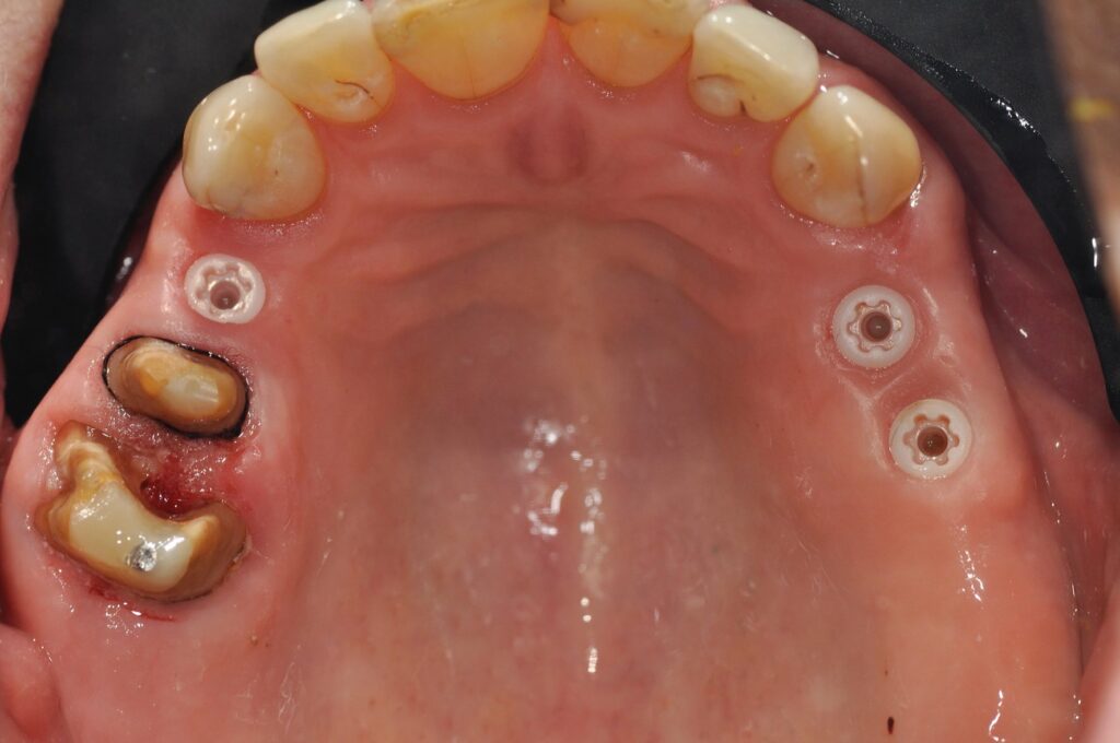 Implant Ceralog en place.