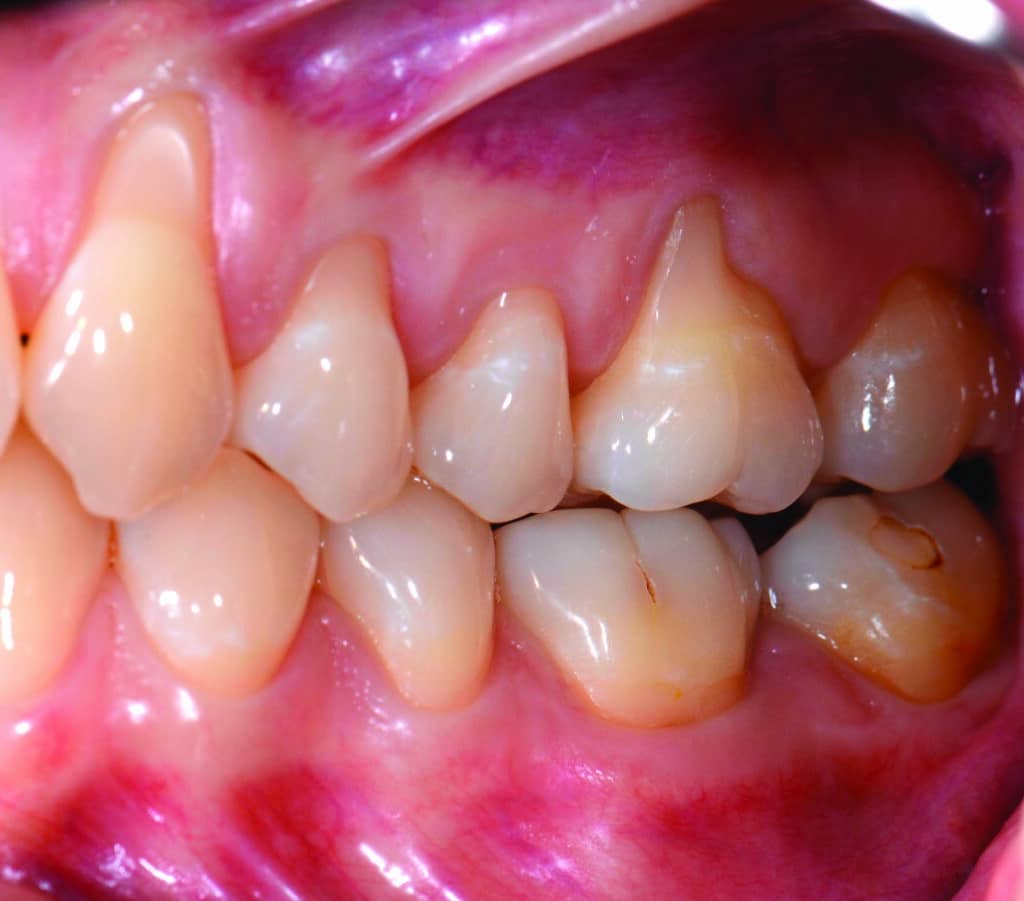 Récessions gingivales