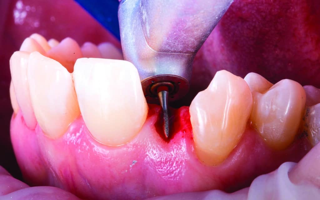 Préparation gingivale pour le bridge cantilever
