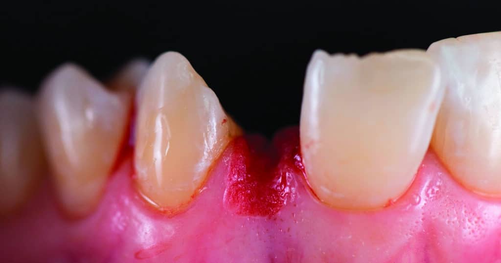 Vue après préparation gingivale.