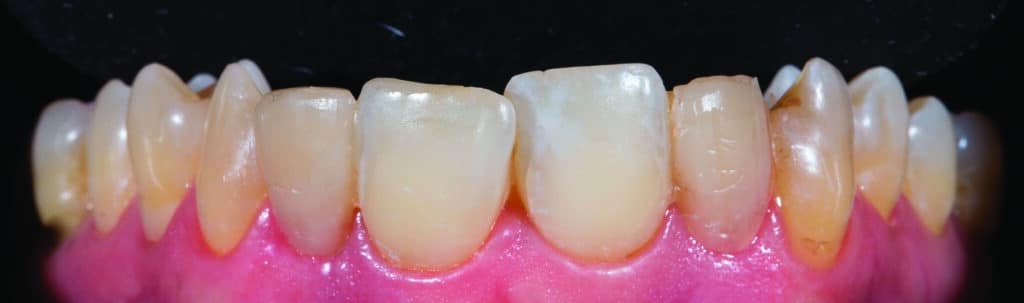 Cicatrisation gingivale