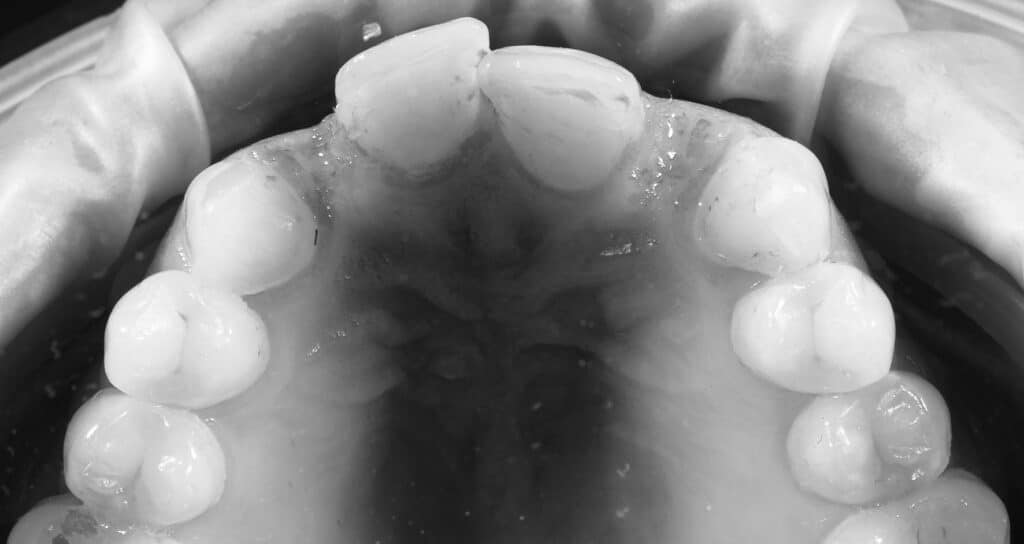 Cicatrisation gingivale