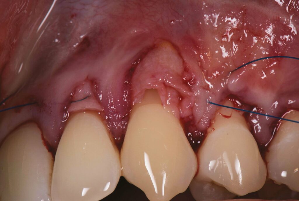 Traitement récessions gingivales