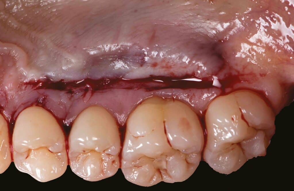 Greffe récessions gingivales