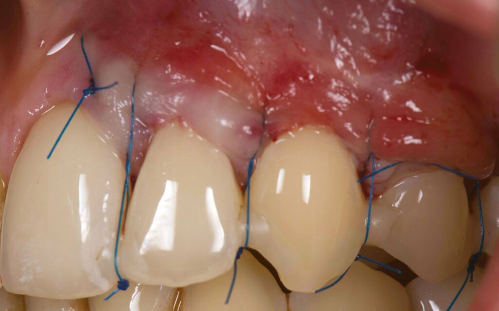 Récessions gingivales cicatrisation