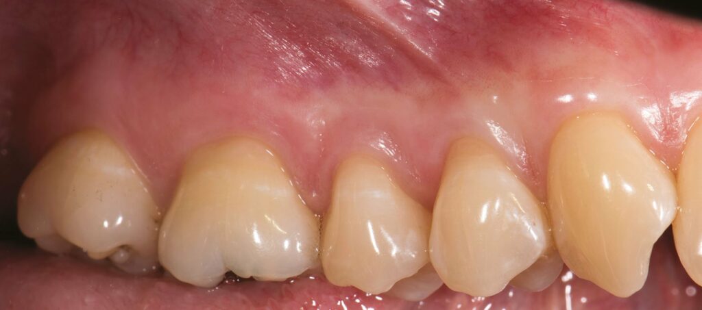 Traitement récessions gingivales