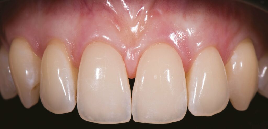 récession gingivale